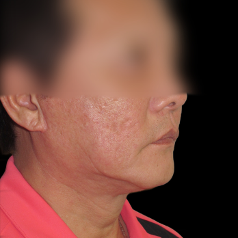 male-facelift-after